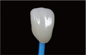 CERLEAD ultra-thin aesthetic veneers — ≥0.15 mm, no-prep or minimally invasive