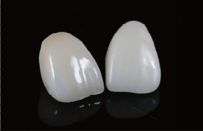 CERLEAD single crown restoration balancing function and aesthetics