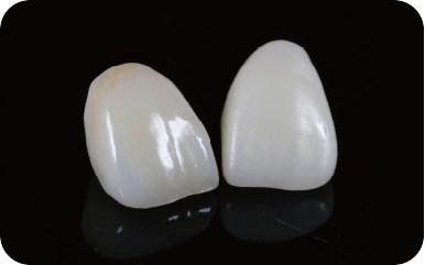 REECHMERRY Single Crown — nano-zirconia dental restoration