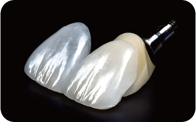 REECHMERRY Veneer — nano-zirconia dental restoration