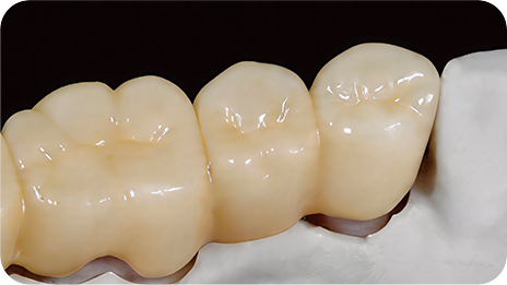 REECHFIRM Multi-unit fixed bridges — clinical indication