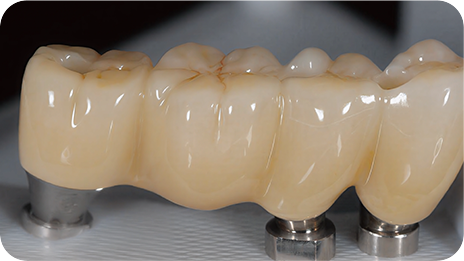 REECHFIRM Implant superstructure restorations — clinical indication