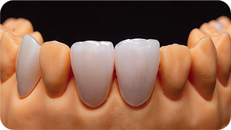 REECHFIRM Routine aesthetic restorations — clinical indication